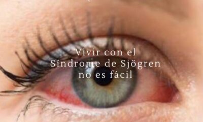 Sindrome sjogren